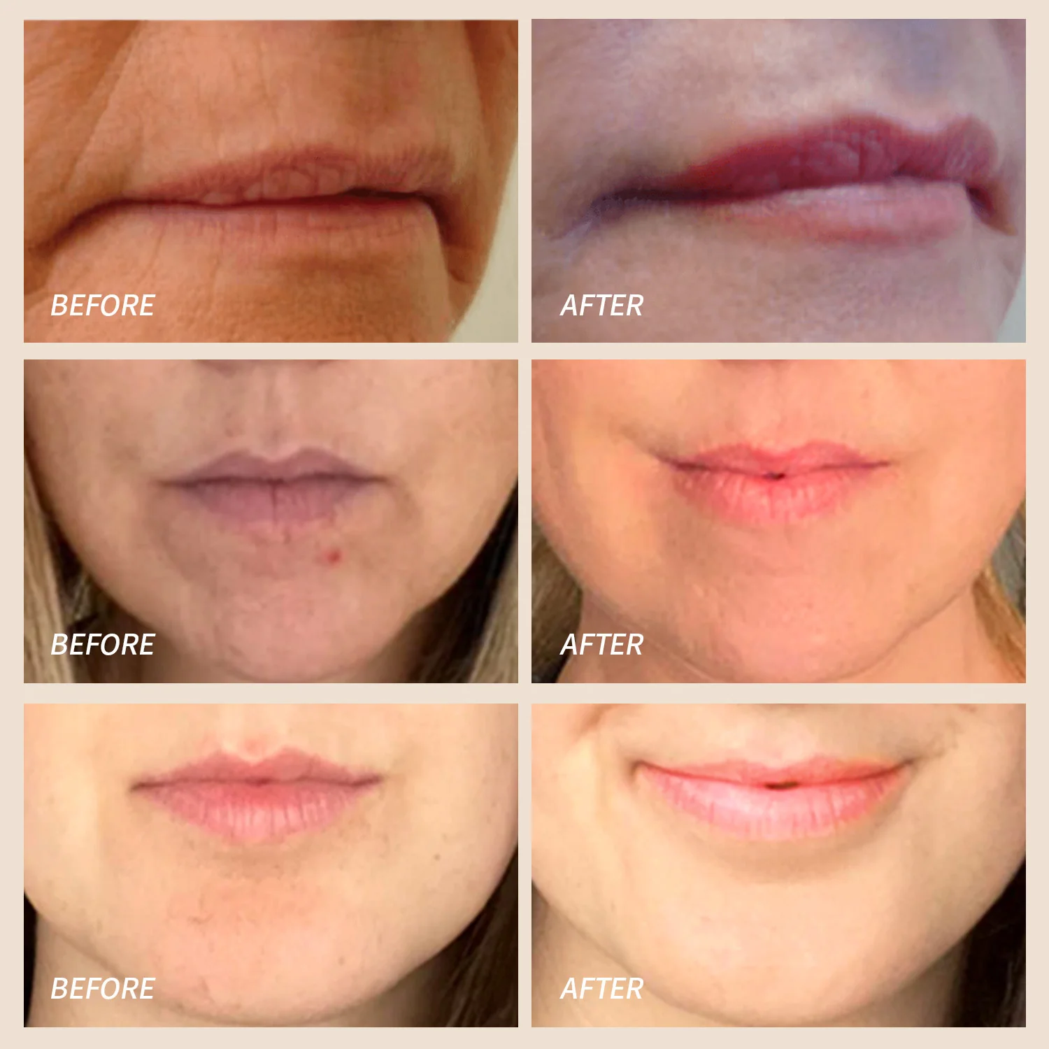 Red Light Therapy for Lips | LED Lip Perfector Plumper Puller lips| Reduce Fine lines