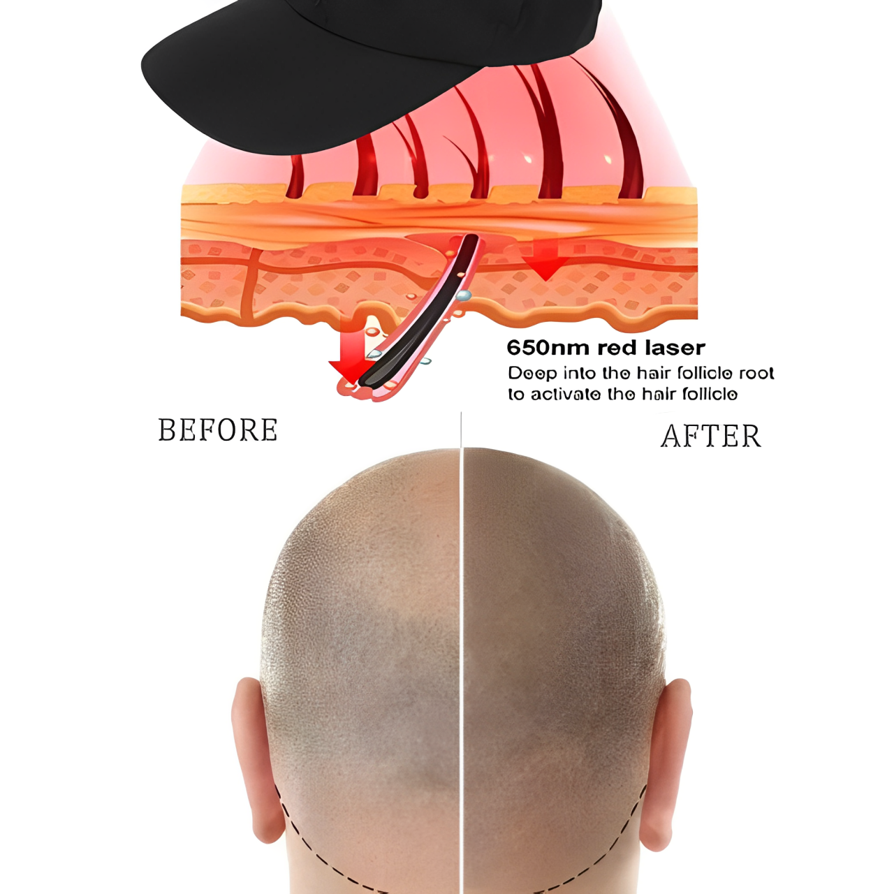 Medical-Grade Laser Cap for Hair Growth