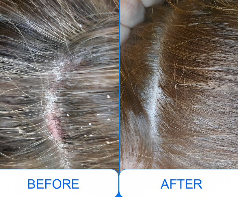 Pro cordless Narrowband Handheld UVB 311 Nm Lamp