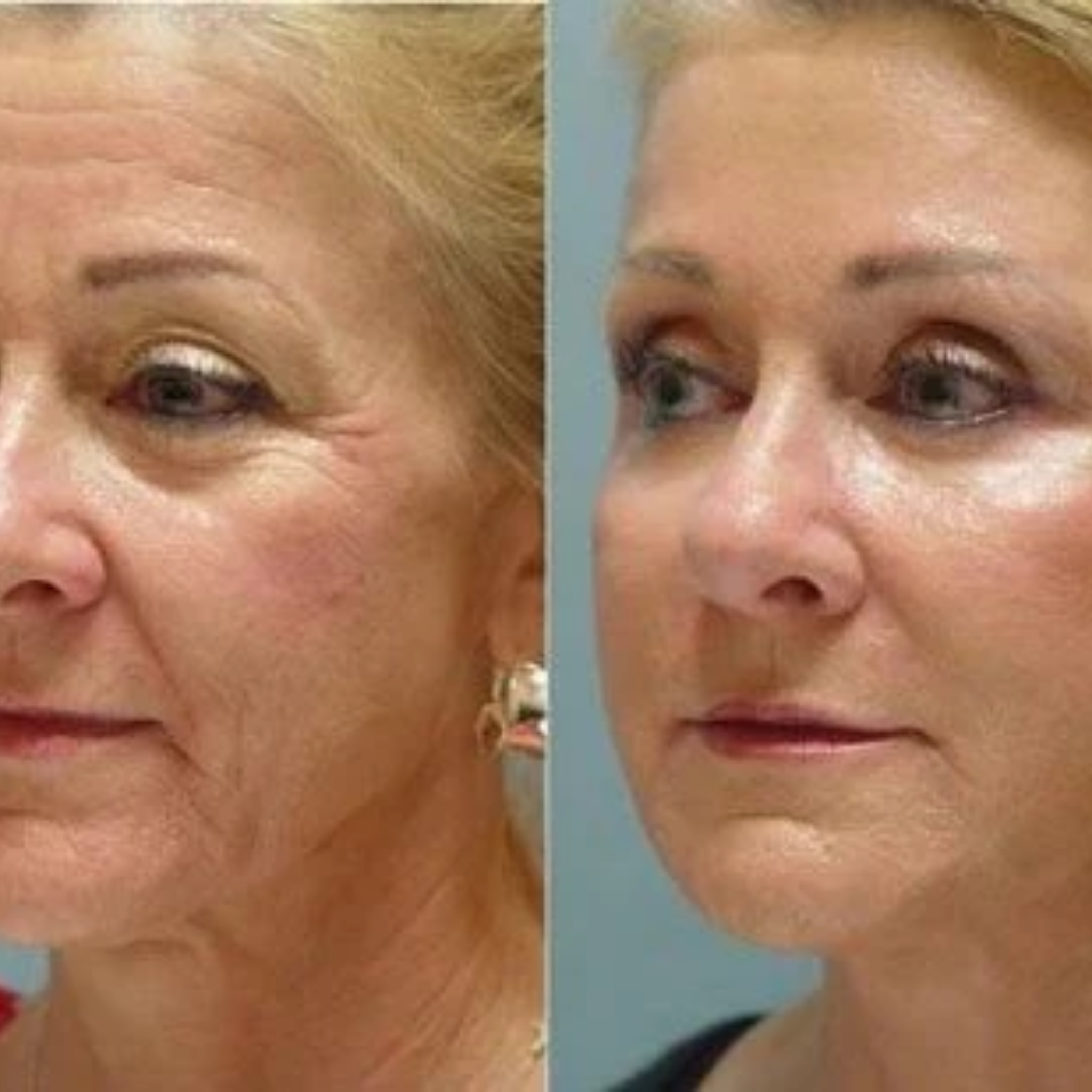 Professional 7-Color LED Phototherapy Mask | for Anti-Aging, Acne & Skin Rejuvenation