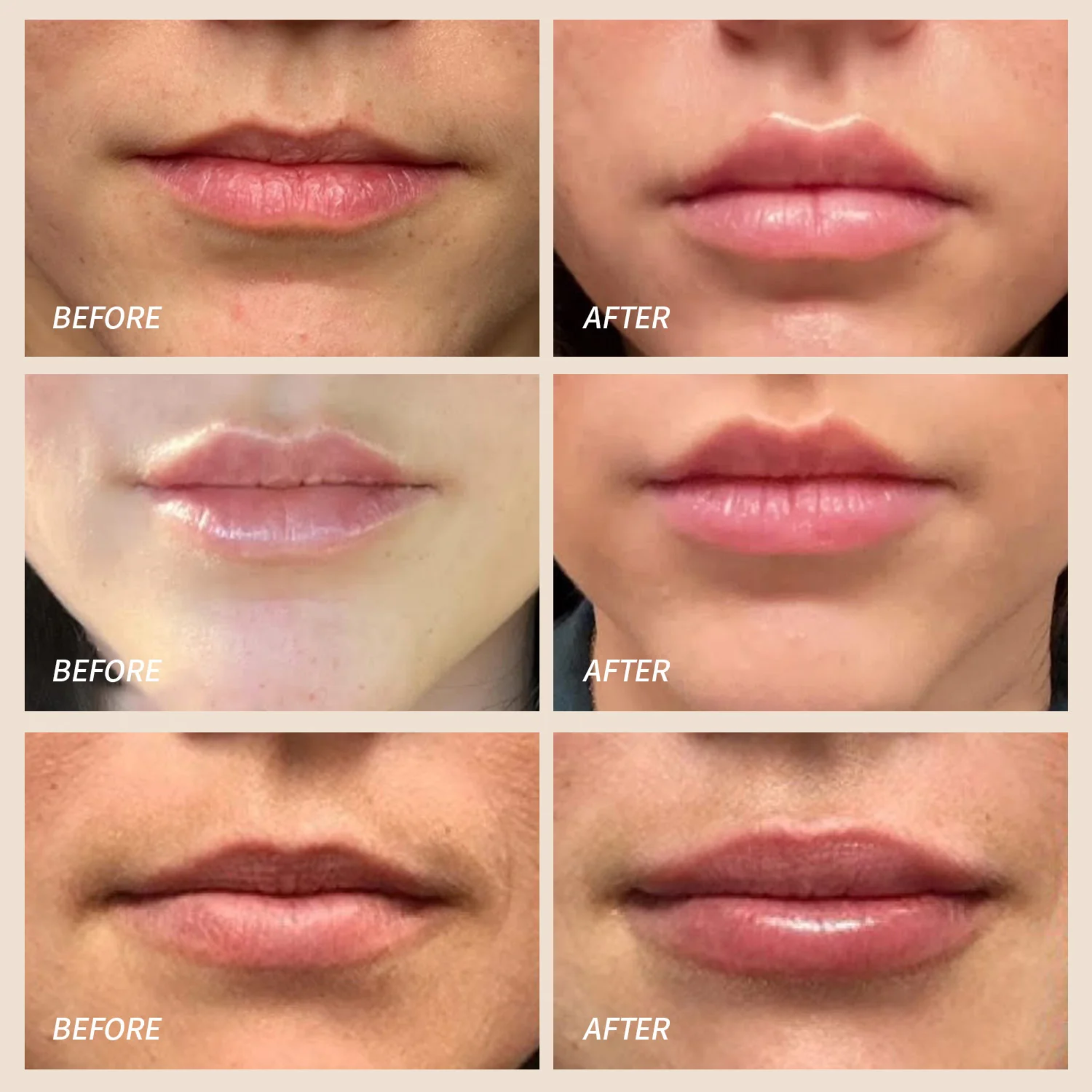 Red Light Therapy for Lips | LED Lip Perfector Plumper Puller lips| Reduce Fine lines