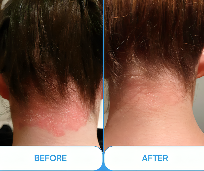 Pro cordless Narrowband Handheld UVB 311 Nm Lamp