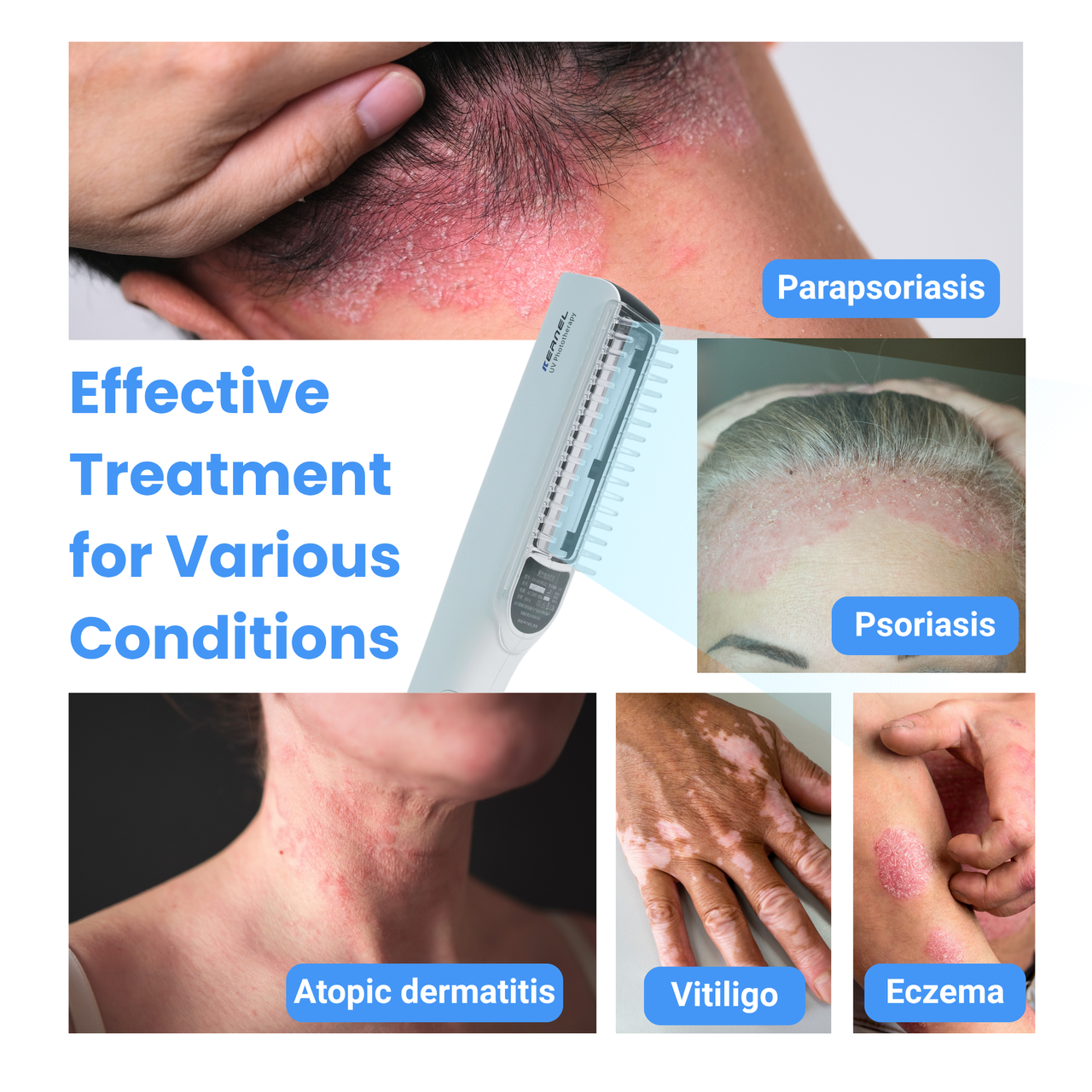 Pro cordless Narrowband Handheld UVB 311 Nm Lamp