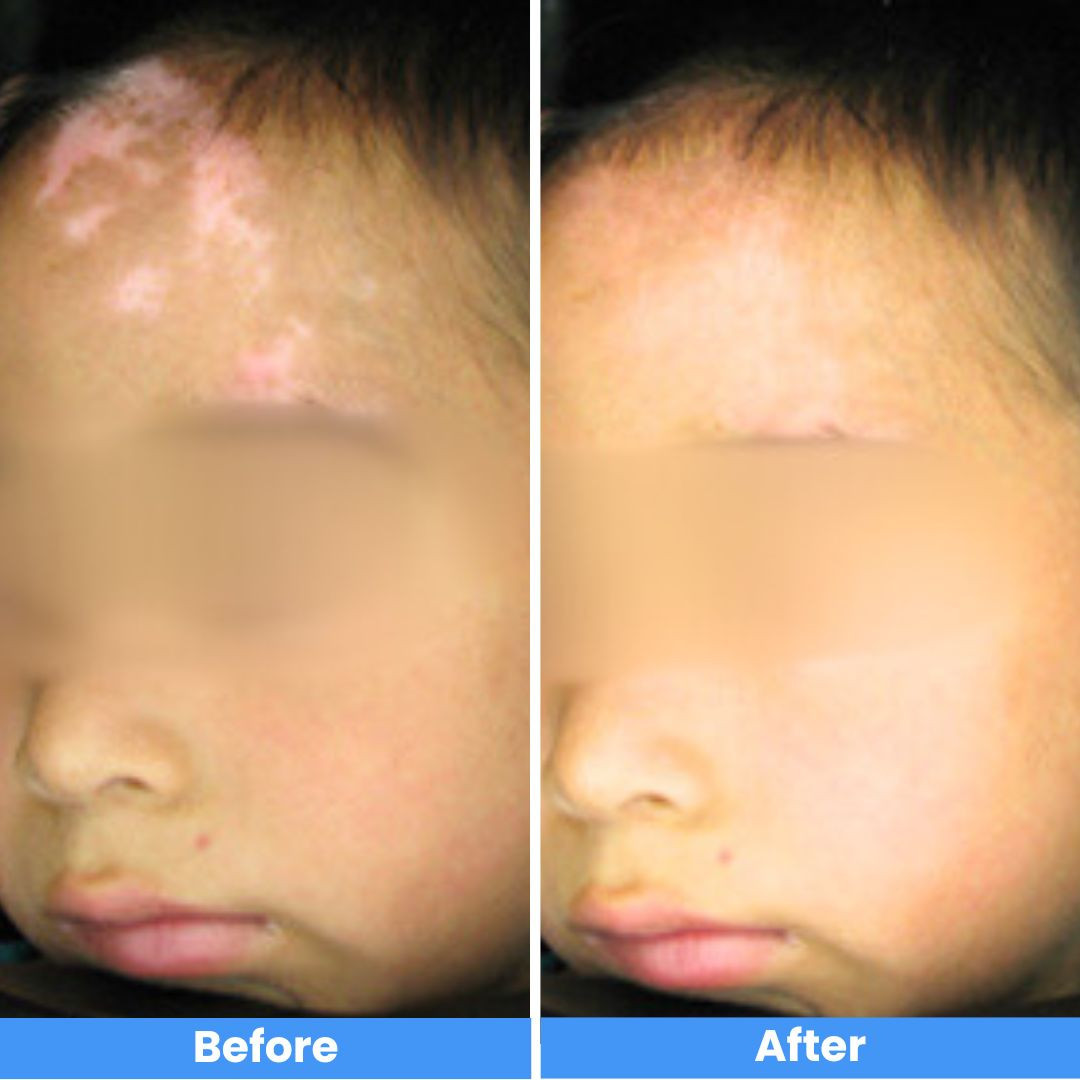 Pro cordless Narrowband Handheld UVB 311 Nm Lamp