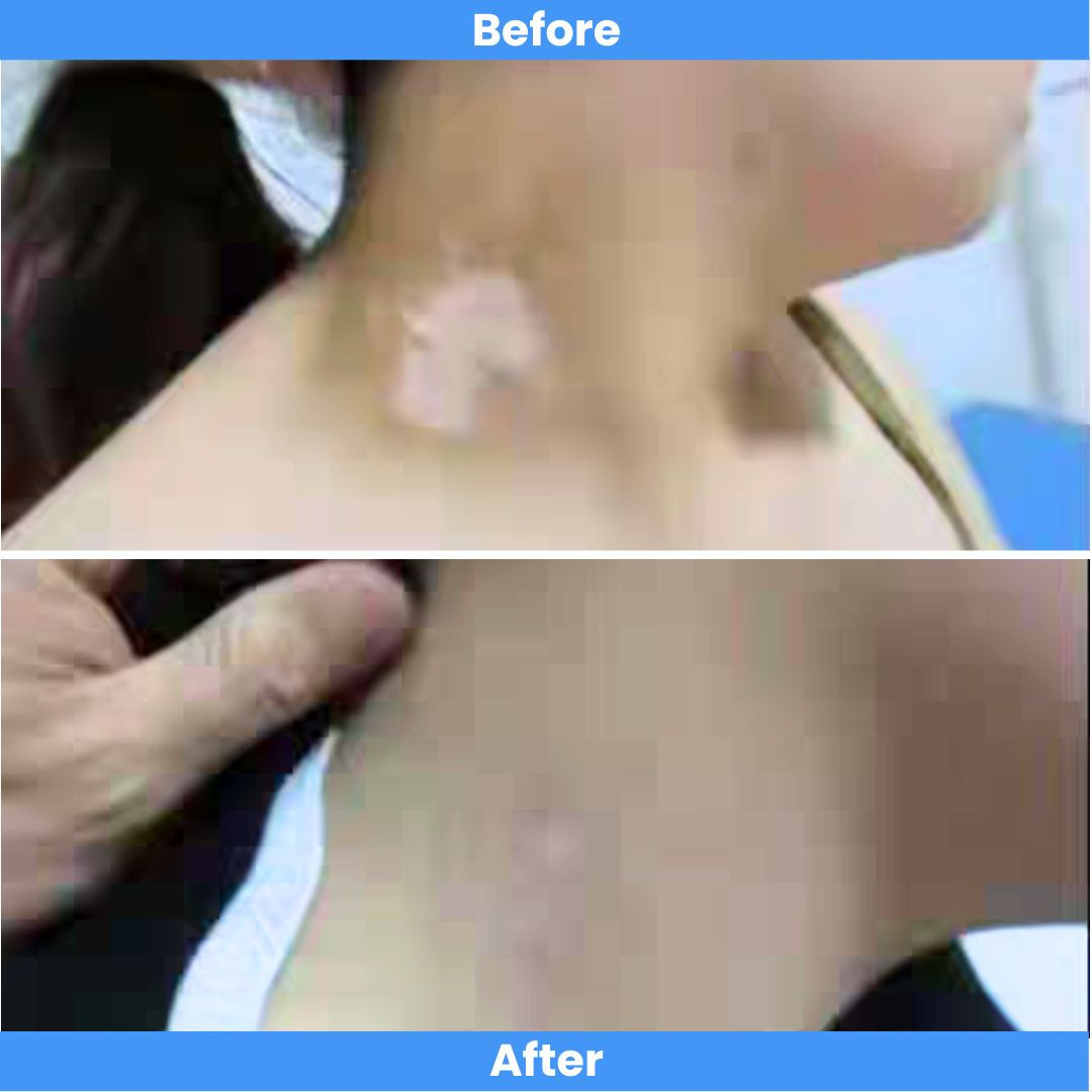 Pro cordless Narrowband Handheld UVB 311 Nm Lamp