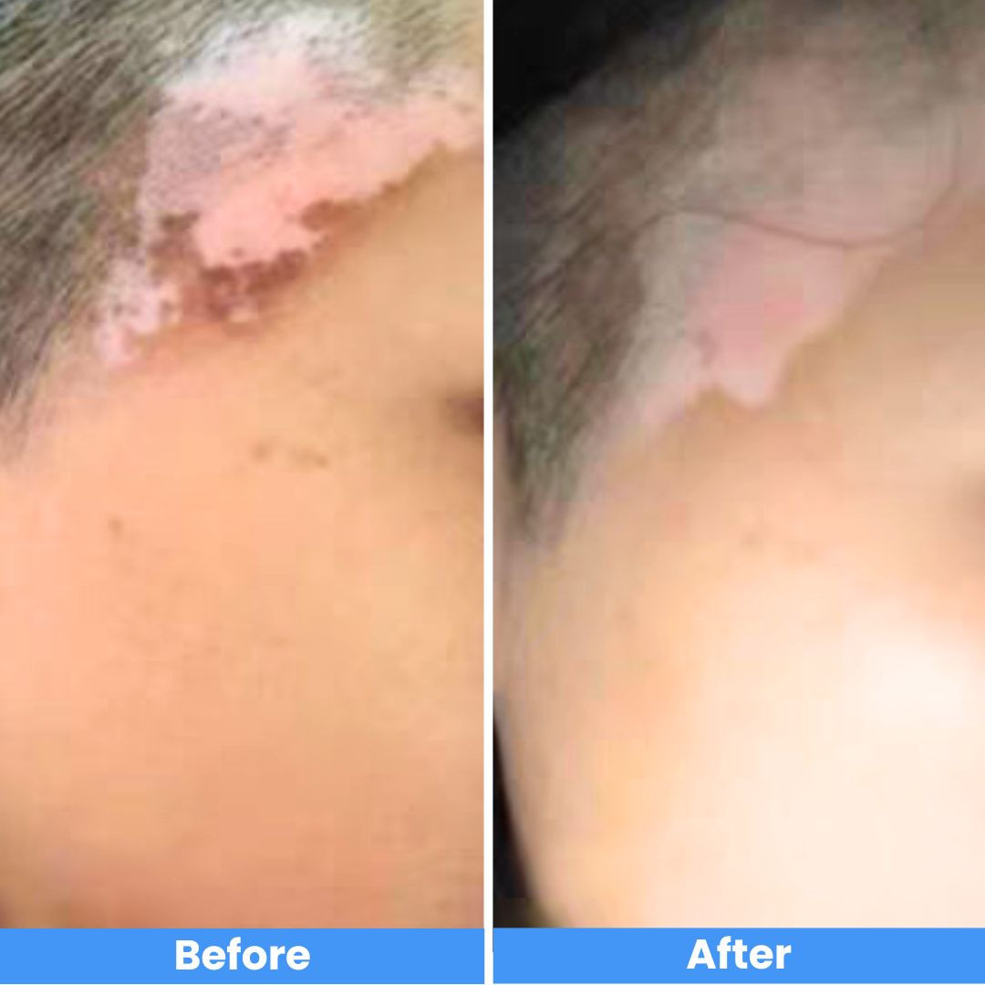 Pro cordless Narrowband Handheld UVB 311 Nm Lamp