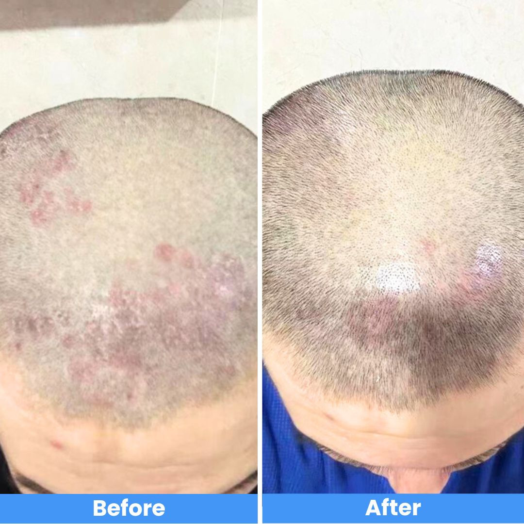 Pro cordless Narrowband Handheld UVB 311 Nm Lamp